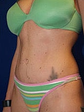 Tummy Tuck Before & After