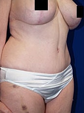 Tummy Tuck Before & After