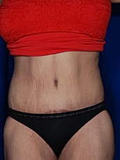 Tummy Tuck Before & After