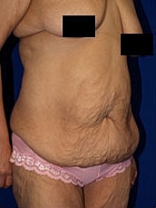 Tummy Tuck Before & After