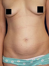 Tummy Tuck Before & After