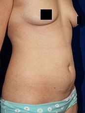 Tummy Tuck Before & After