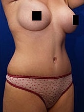 Tummy Tuck Before & After