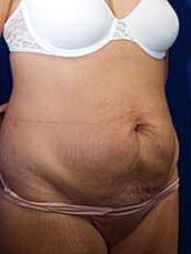 Tummy Tuck Before & After