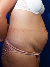 Tummy Tuck Before & After