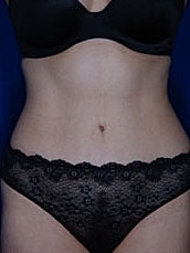 Tummy Tuck Before & After