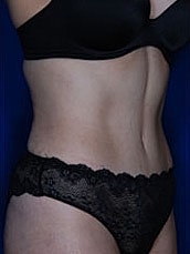 Tummy Tuck Before & After