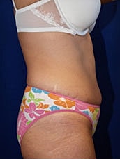 Tummy Tuck Before & After