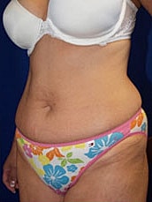 Tummy Tuck Before & After