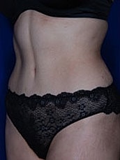 Tummy Tuck Before & After