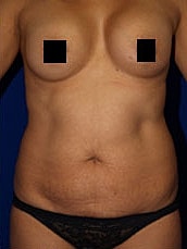 Tummy Tuck Before & After