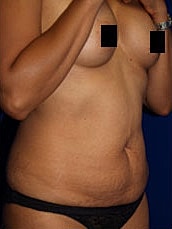 Tummy Tuck Before & After