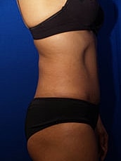 Tummy Tuck Before & After
