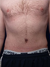 Tummy Tuck Before & After