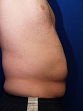 Tummy Tuck Before & After