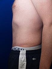 Tummy Tuck Before & After