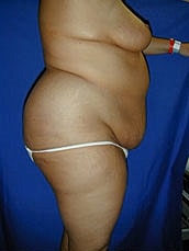 Tummy Tuck Before & After