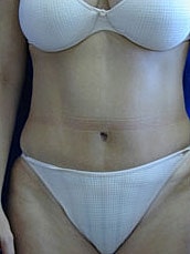 Tummy Tuck Before & After