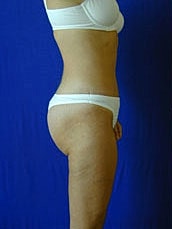 Tummy Tuck Before & After
