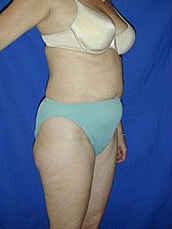 Tummy Tuck Before & After