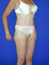 Tummy Tuck Before & After
