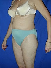Tummy Tuck Before & After