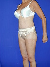 Tummy Tuck Before & After