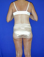 Tummy Tuck Before & After