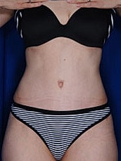 Tummy Tuck Before & After