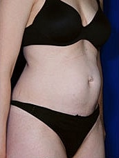 Tummy Tuck Before & After