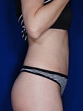 Tummy Tuck Before & After