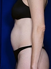Tummy Tuck Before & After