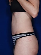 Tummy Tuck Before & After