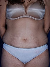 Tummy Tuck Before & After