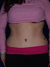 Tummy Tuck Before & After