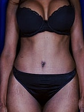 Tummy Tuck Before & After