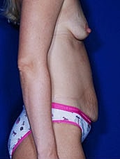 Tummy Tuck Before & After