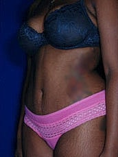 Tummy Tuck Before & After