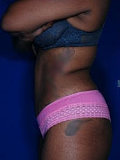 Tummy Tuck Before & After