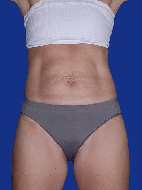 Tummy Tuck Before & After