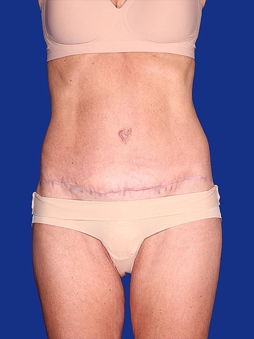 Tummy Tuck Before & After