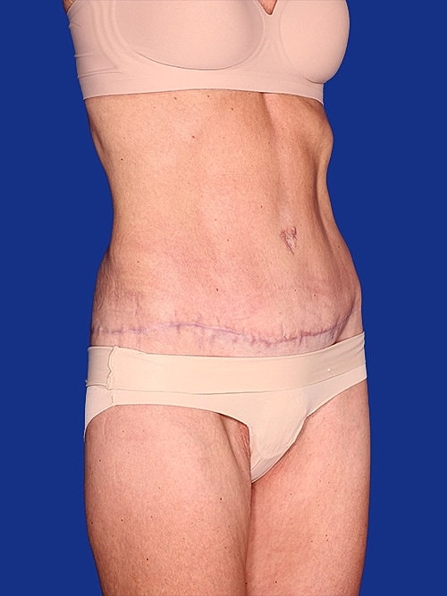Tummy Tuck Before & After