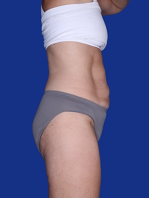 Tummy Tuck Before & After