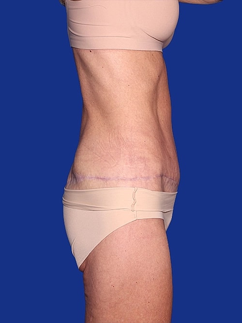 Tummy Tuck Before & After