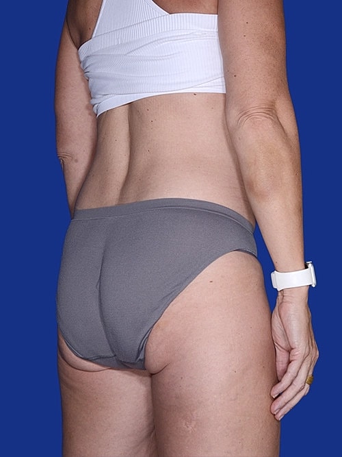 Tummy Tuck Before & After