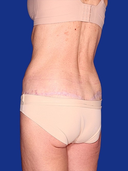 Tummy Tuck Before & After