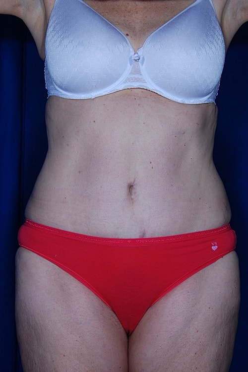 Tummy Tuck Before & After