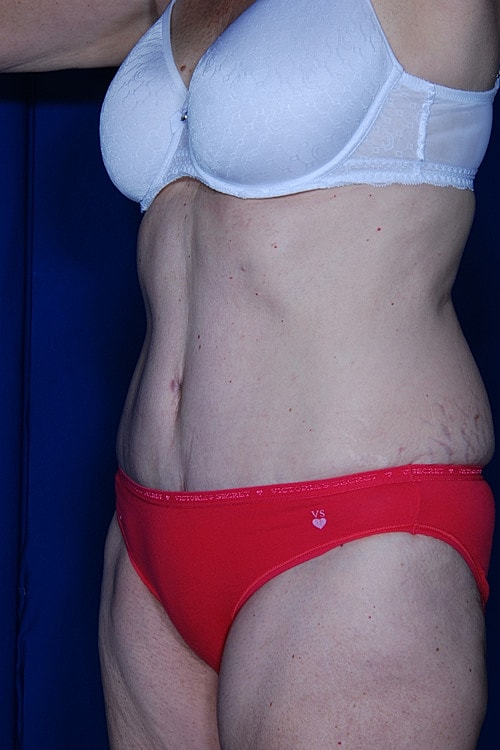 Tummy Tuck Before & After