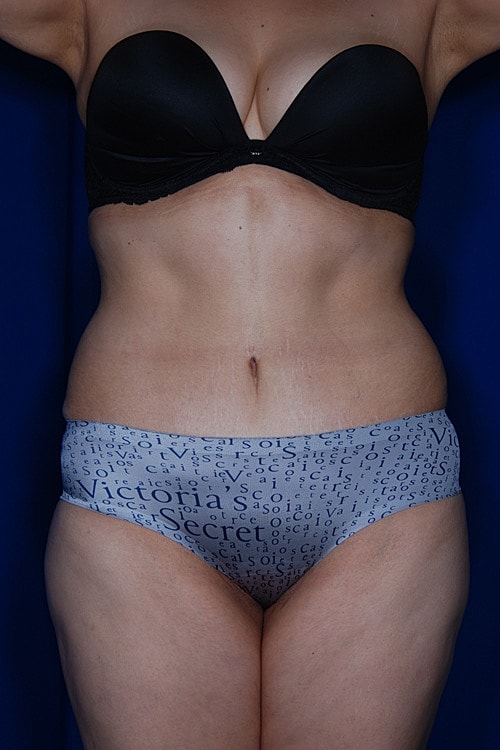 Tummy Tuck Before & After