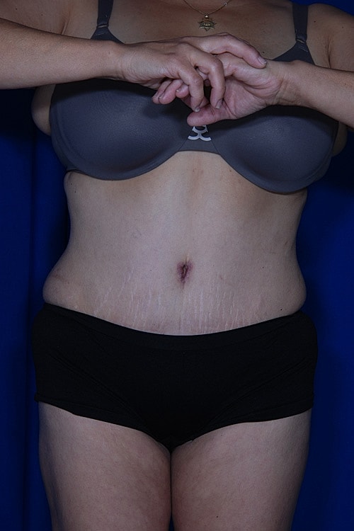 Tummy Tuck Before & After